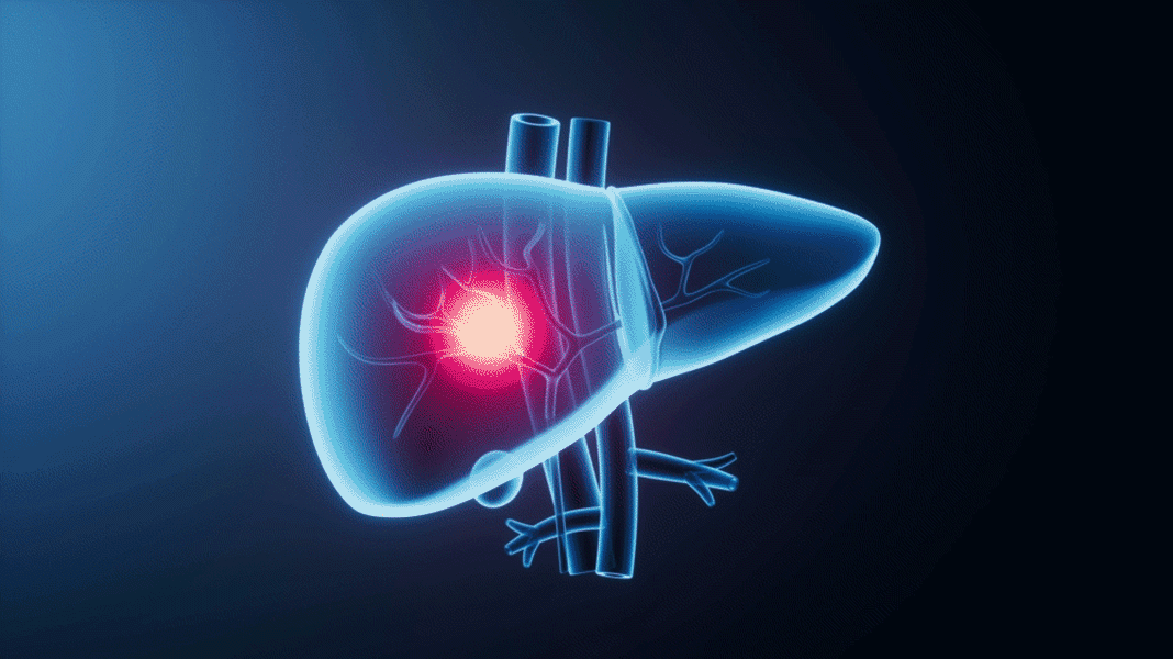 el-informe-liderado-por-china-traza-un-nuevo-curso-para-el-control-global-del-cancer-de-higado